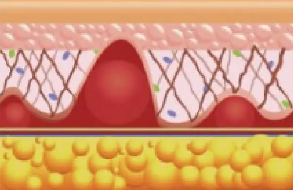 組織膠 皮下血腫