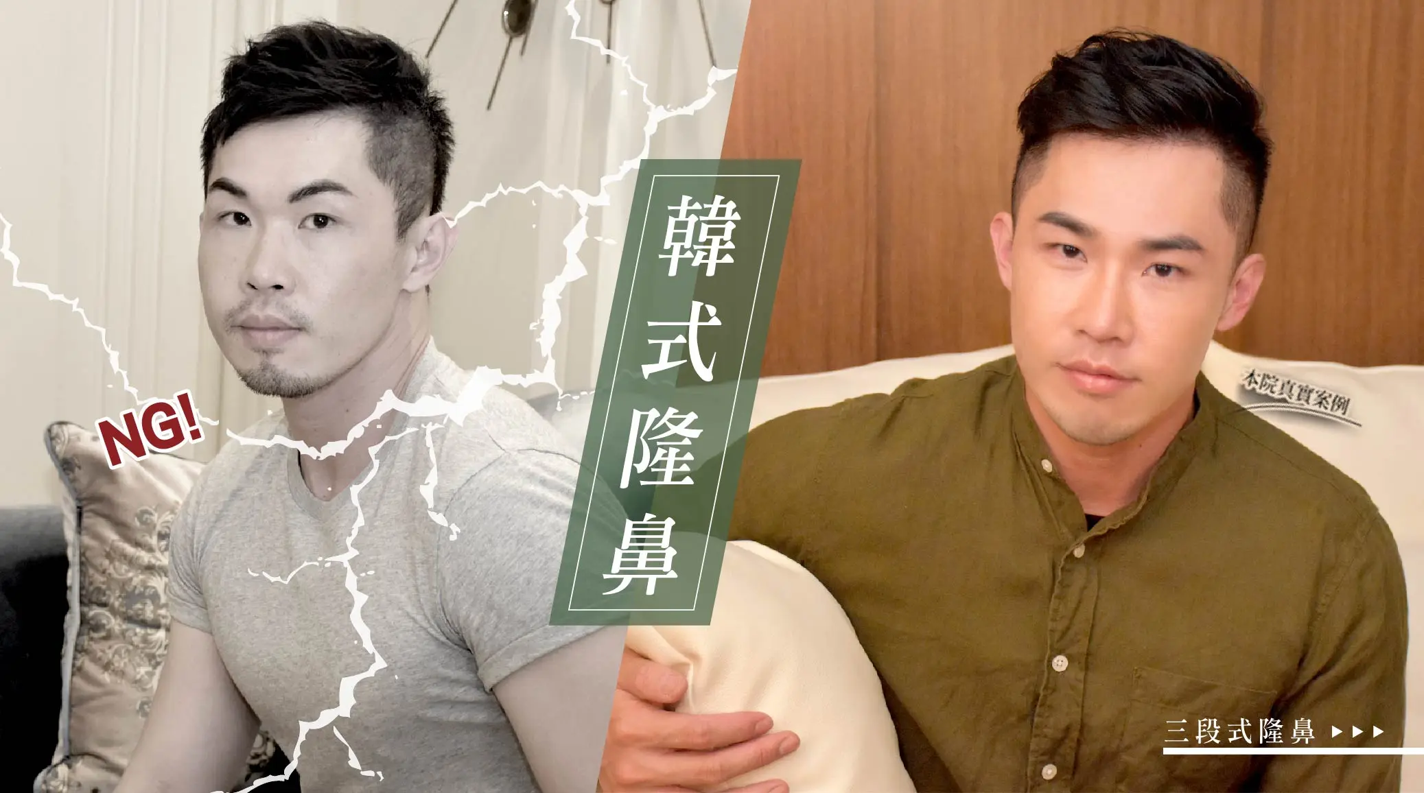 隆鼻