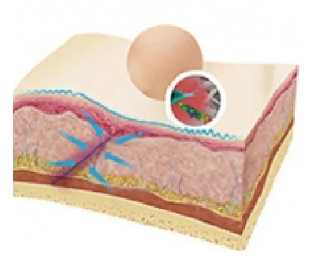 埋線線材 兩個月後