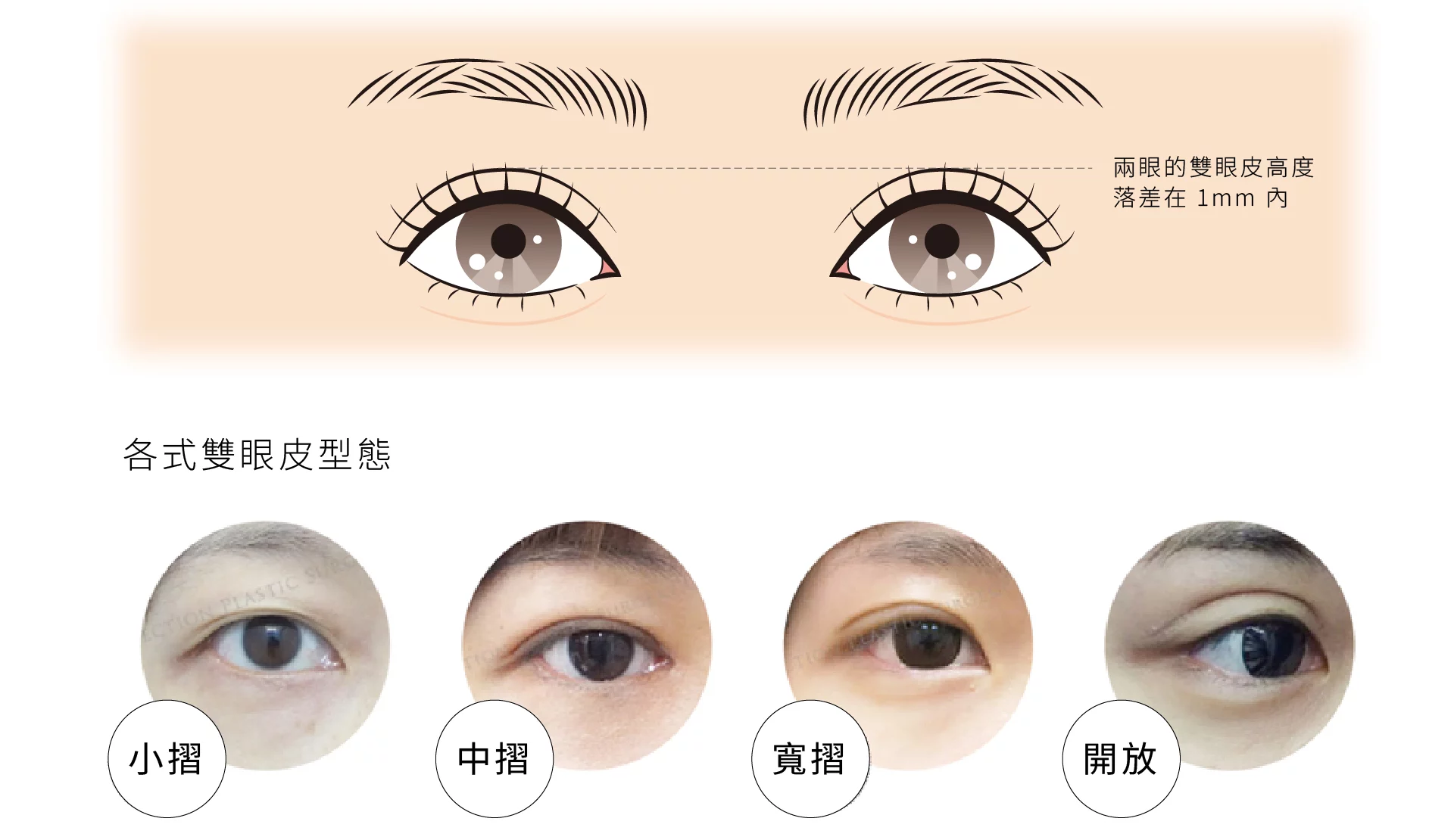 雙眼皮 摺痕