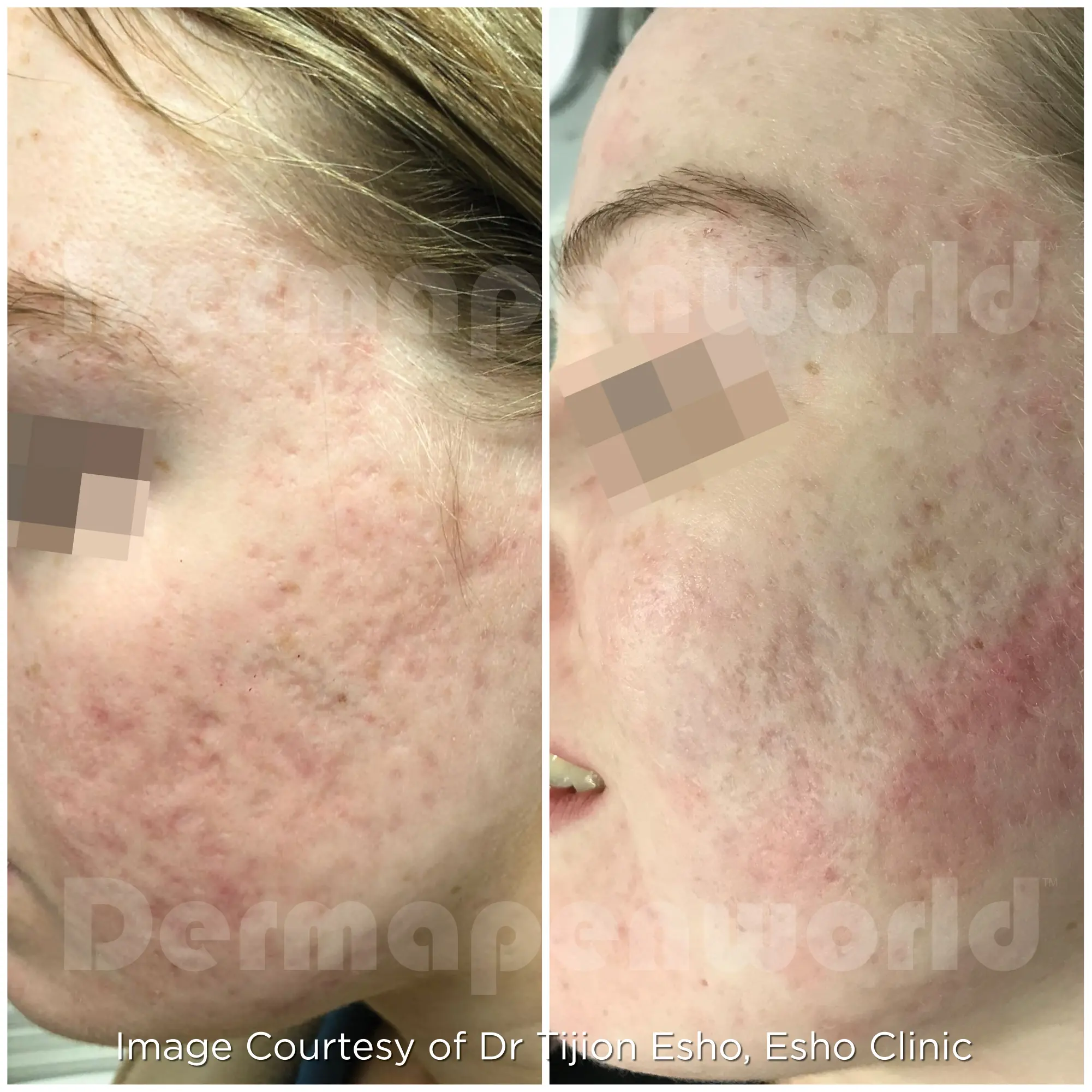 Acne Female 17