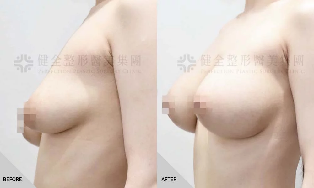 乳房下垂 02