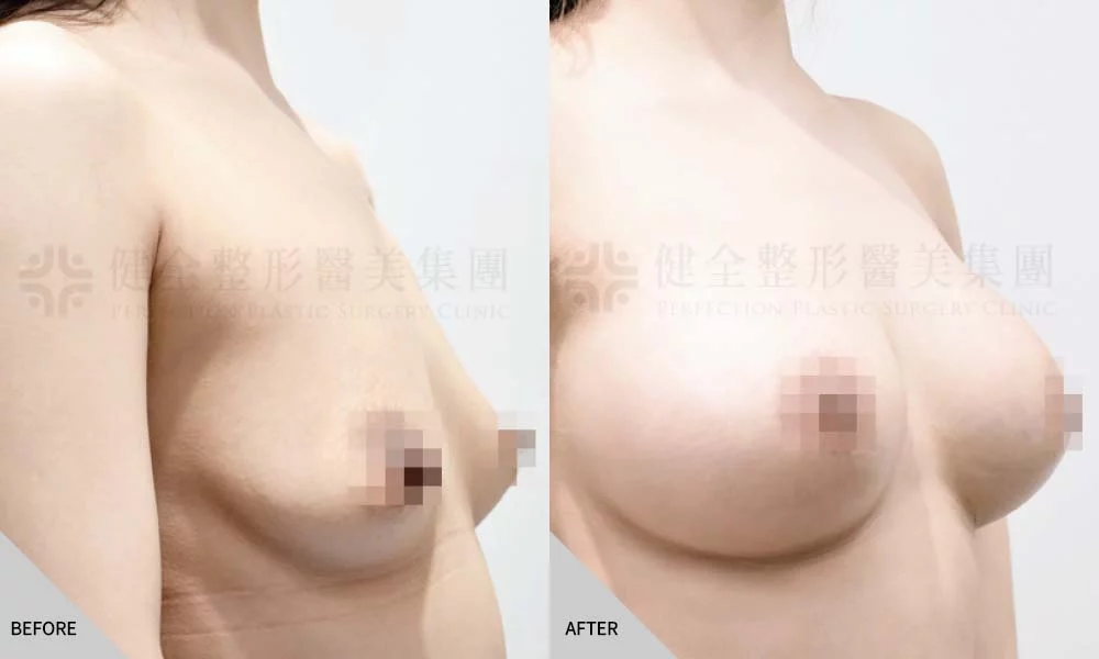 乳房下垂 03