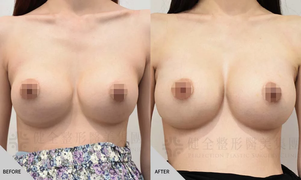 二次隆乳 01
