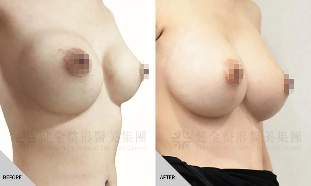 二次隆乳 02