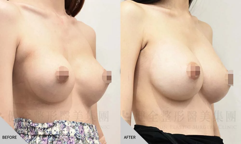 二次隆乳 03