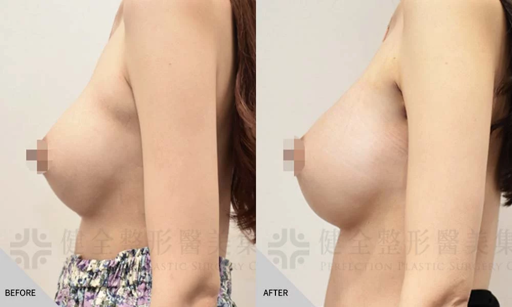 二次隆乳 04