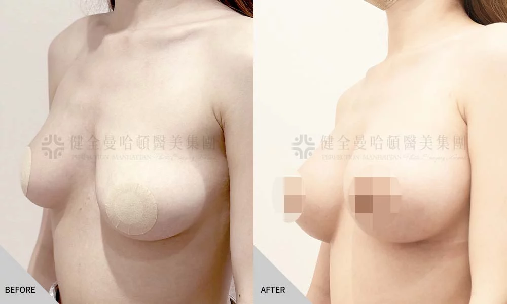 劉倚妮 隆乳 02