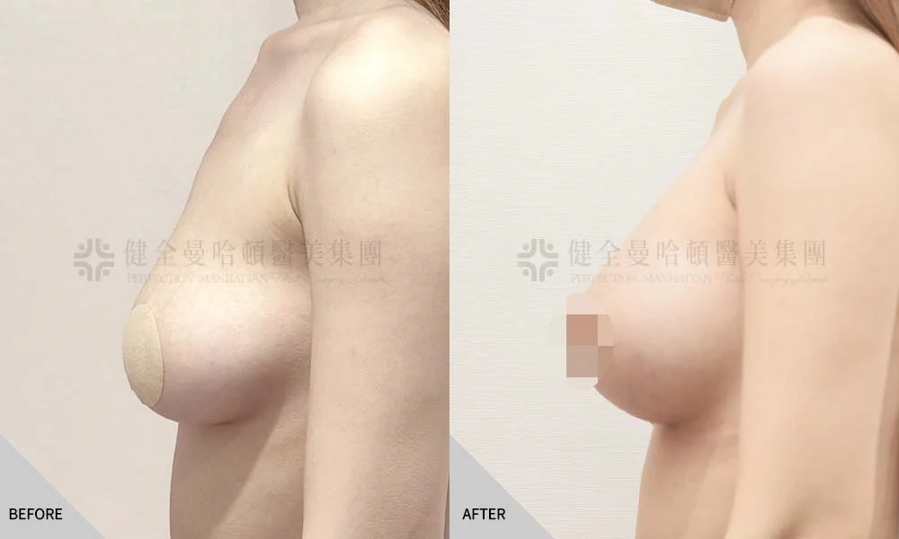 劉倚妮 隆乳 03