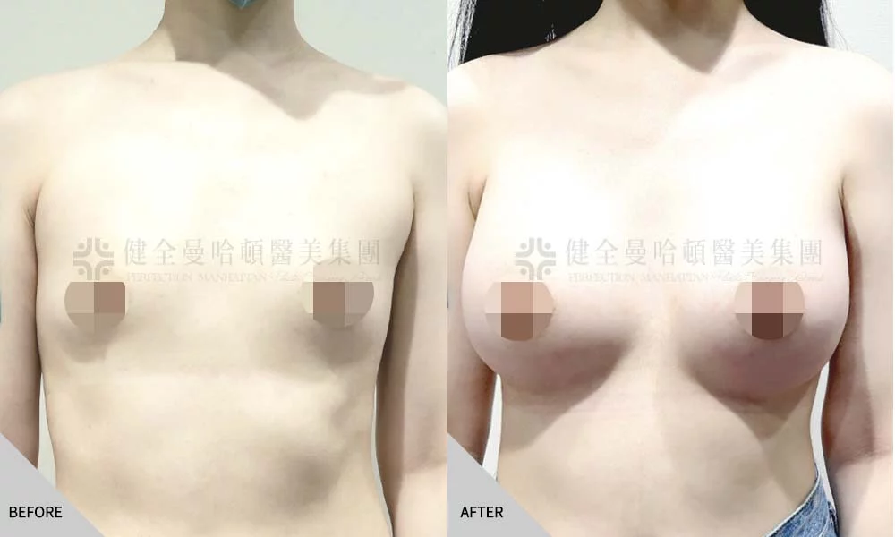 張凱煊 隆乳 01