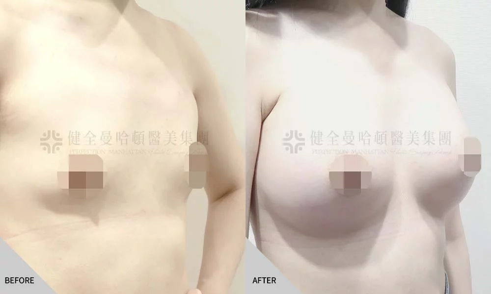 張凱煊 隆乳 02
