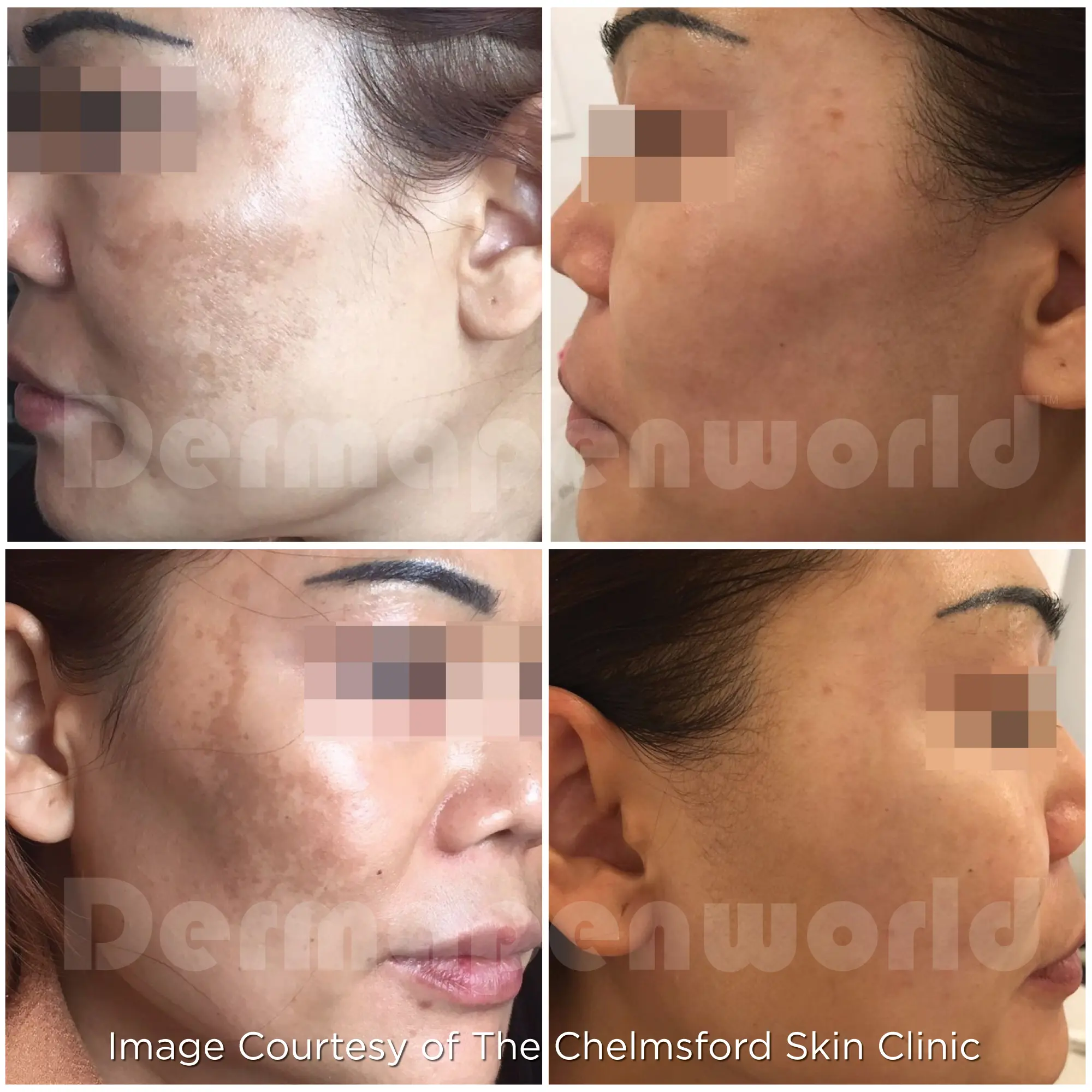 肝斑Melasma Female 1