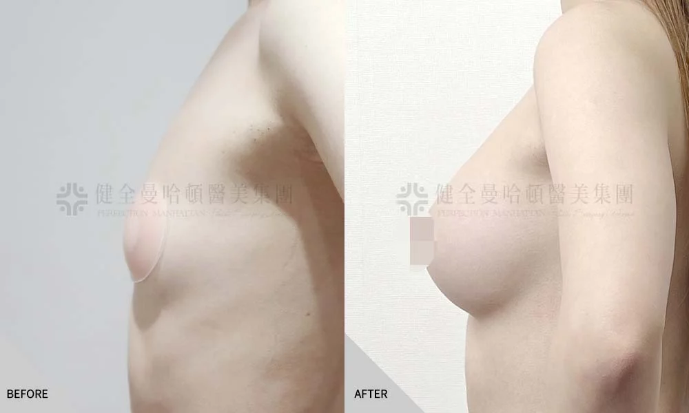 郭惠瑜 隆乳 03