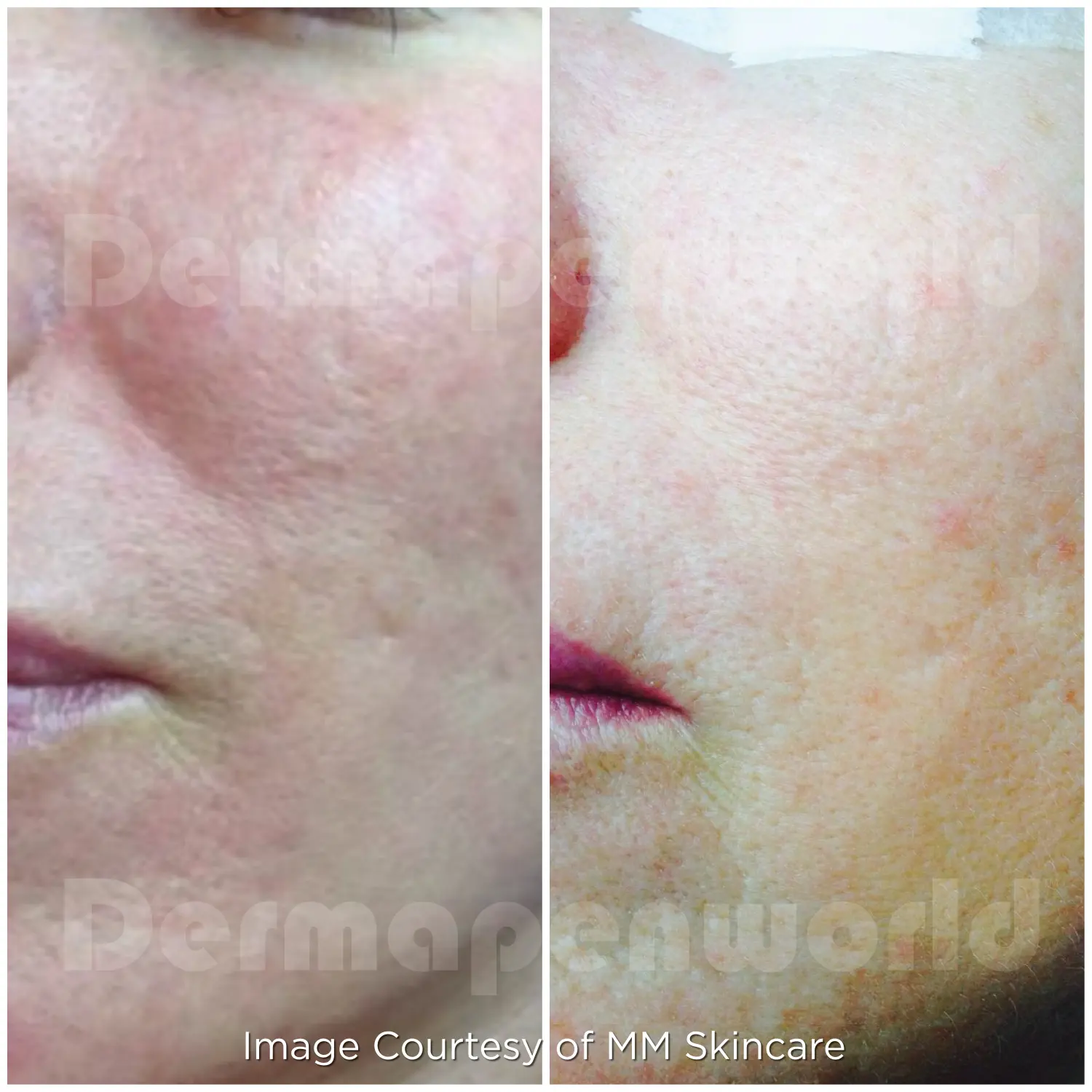 酒糟肌Rosacea Female 5