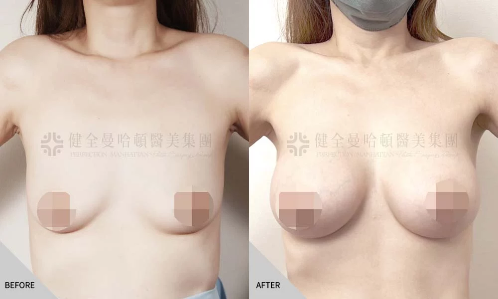 陳蕎榛 隆乳 01
