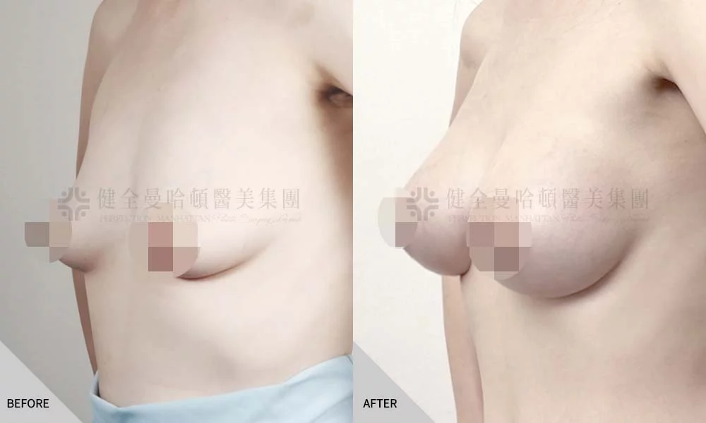 陳蕎榛 隆乳 02