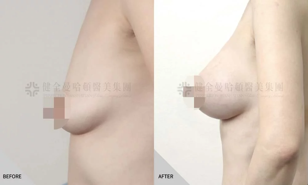 陳蕎榛 隆乳 03