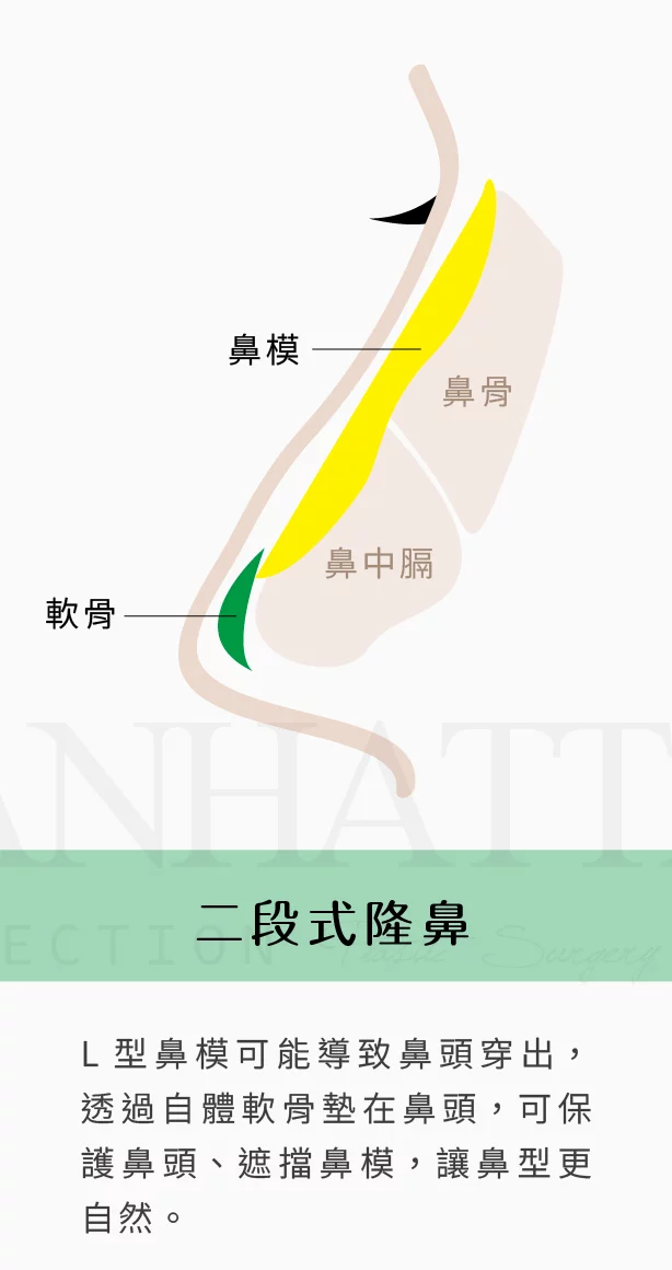 隆鼻 二段式