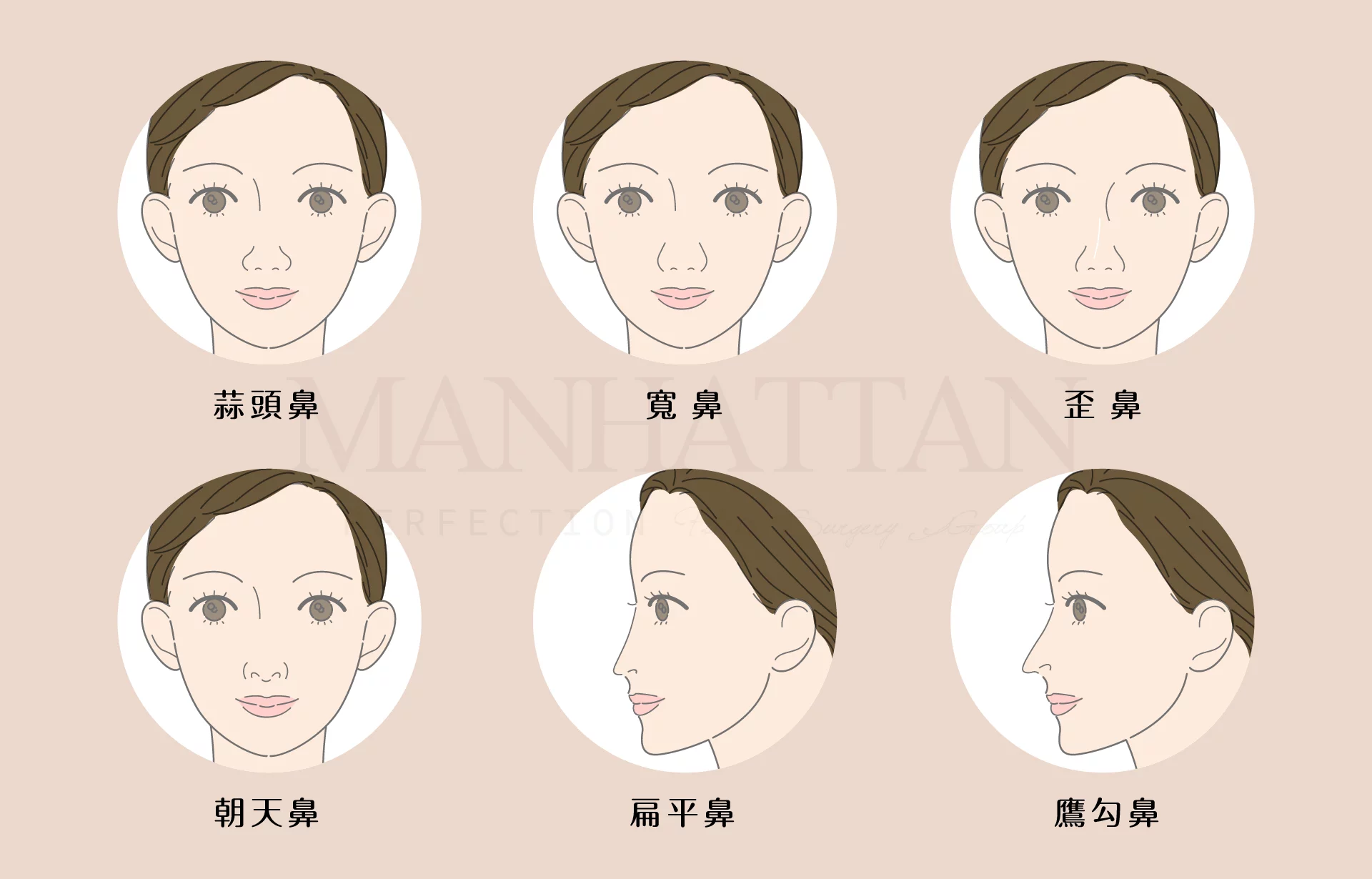隆鼻 鼻子種類
