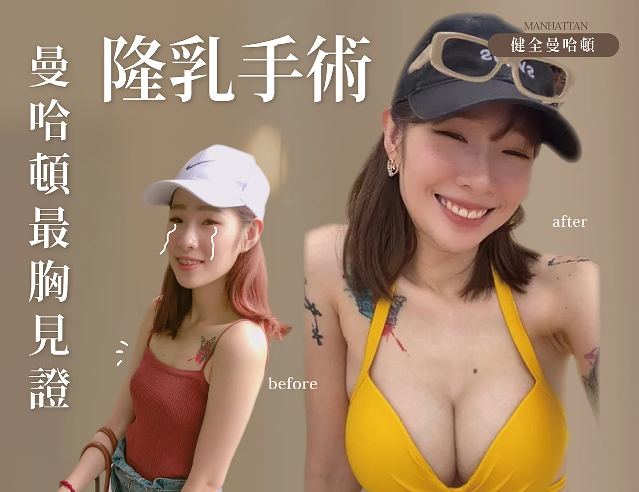 【隆乳】桑妮