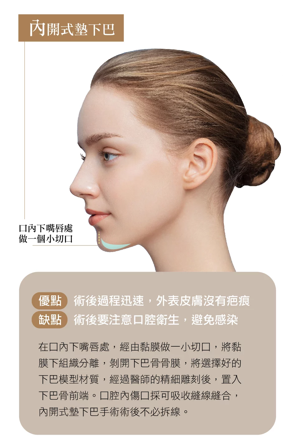 下巴精雕 內開式