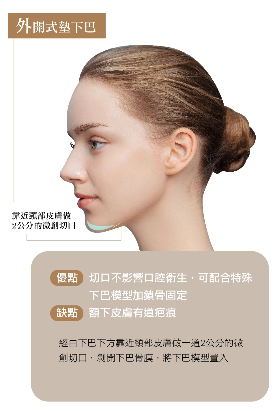 下巴精雕 外開式