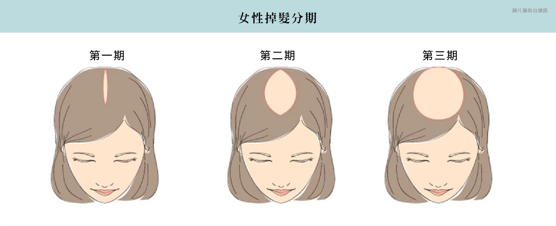植髮 女性