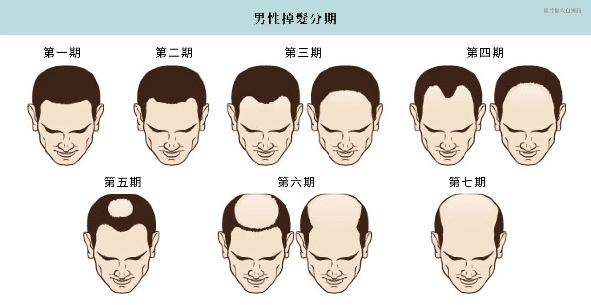 植髮 男性
