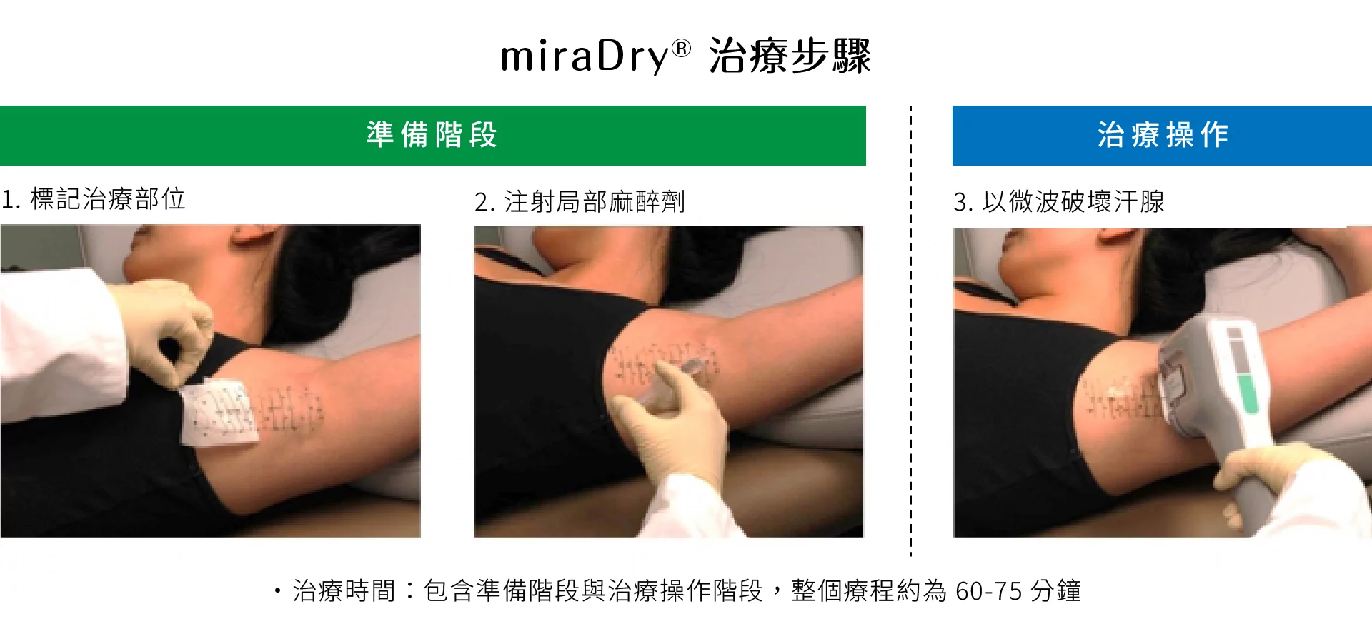 狐臭多汗症 治療步驟