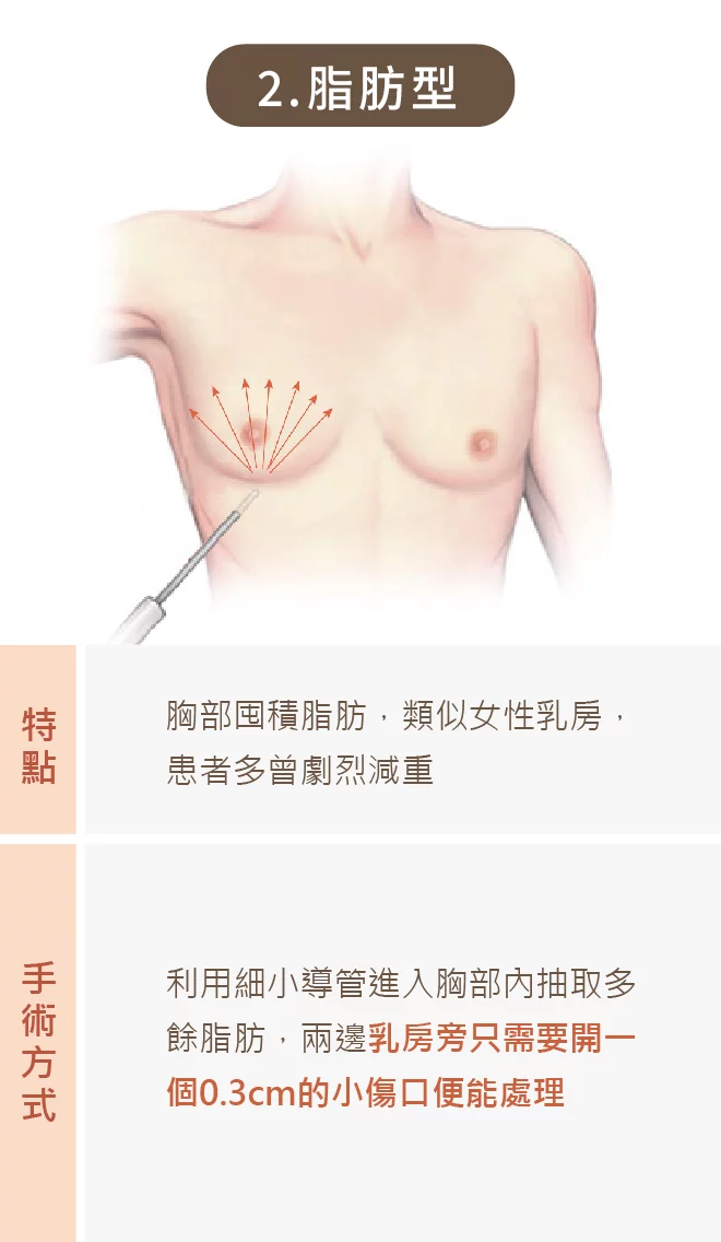 男性女乳 02 