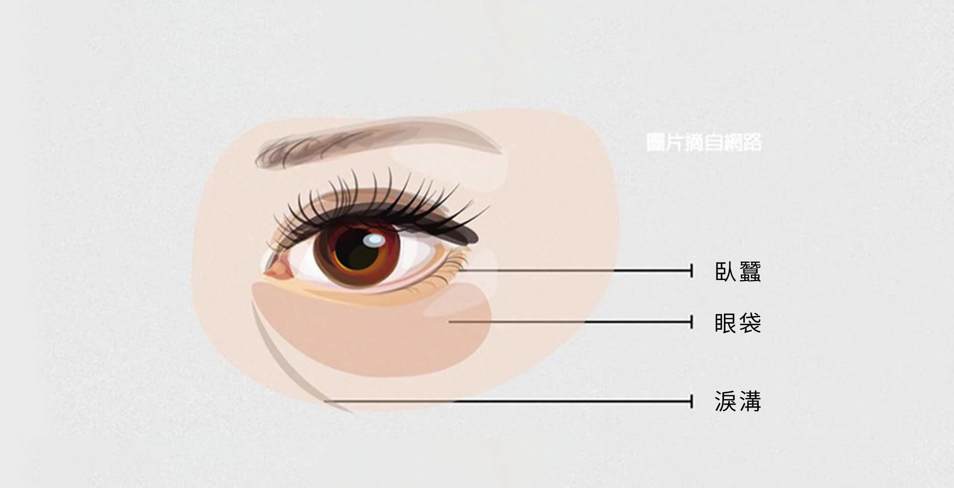 眼袋 淚溝型