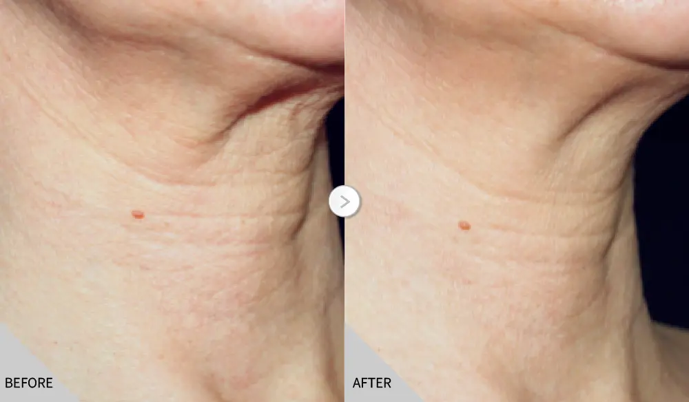 逆時針公告 淡化皺紋 01