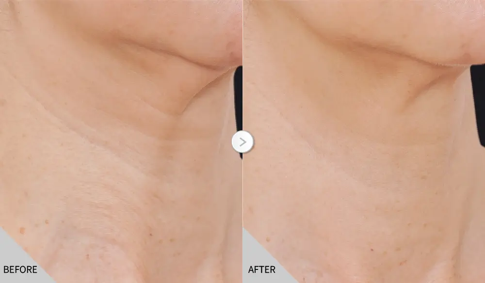 逆時針公告 淡化皺紋 02