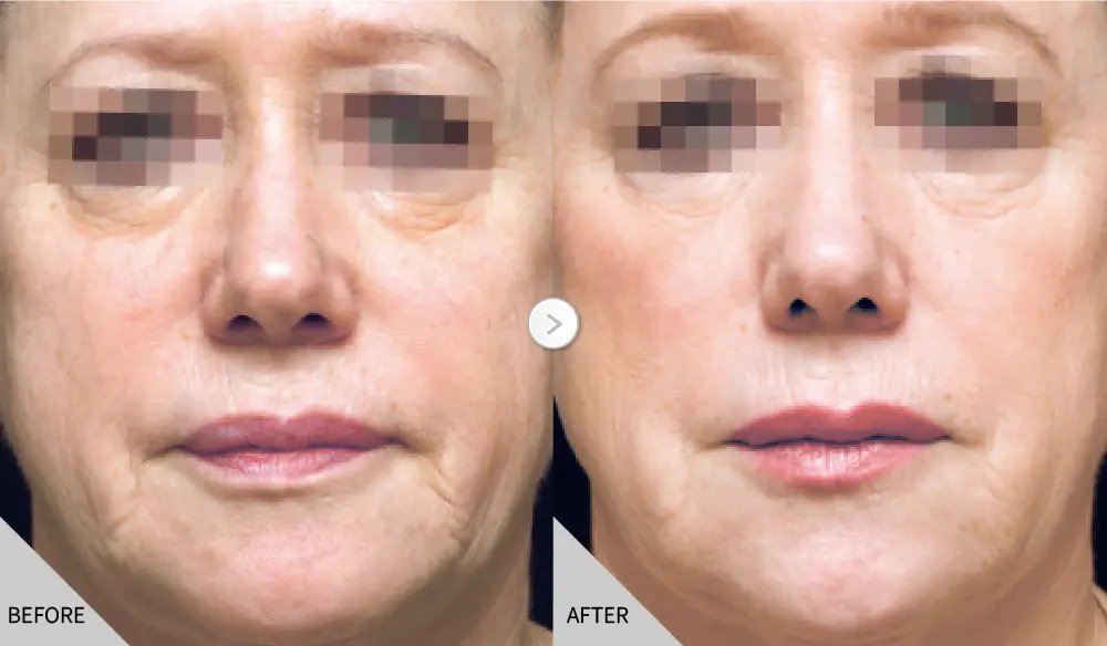 逆時針公告 輪廓塑形 01