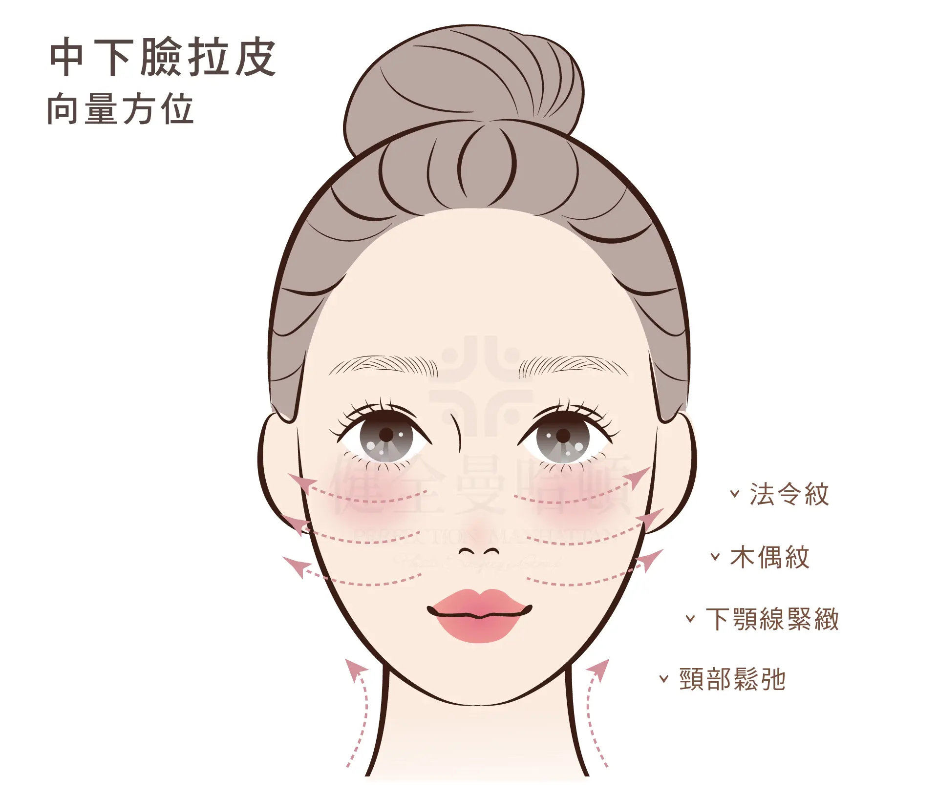 顳側拉皮 中下臉拉皮 