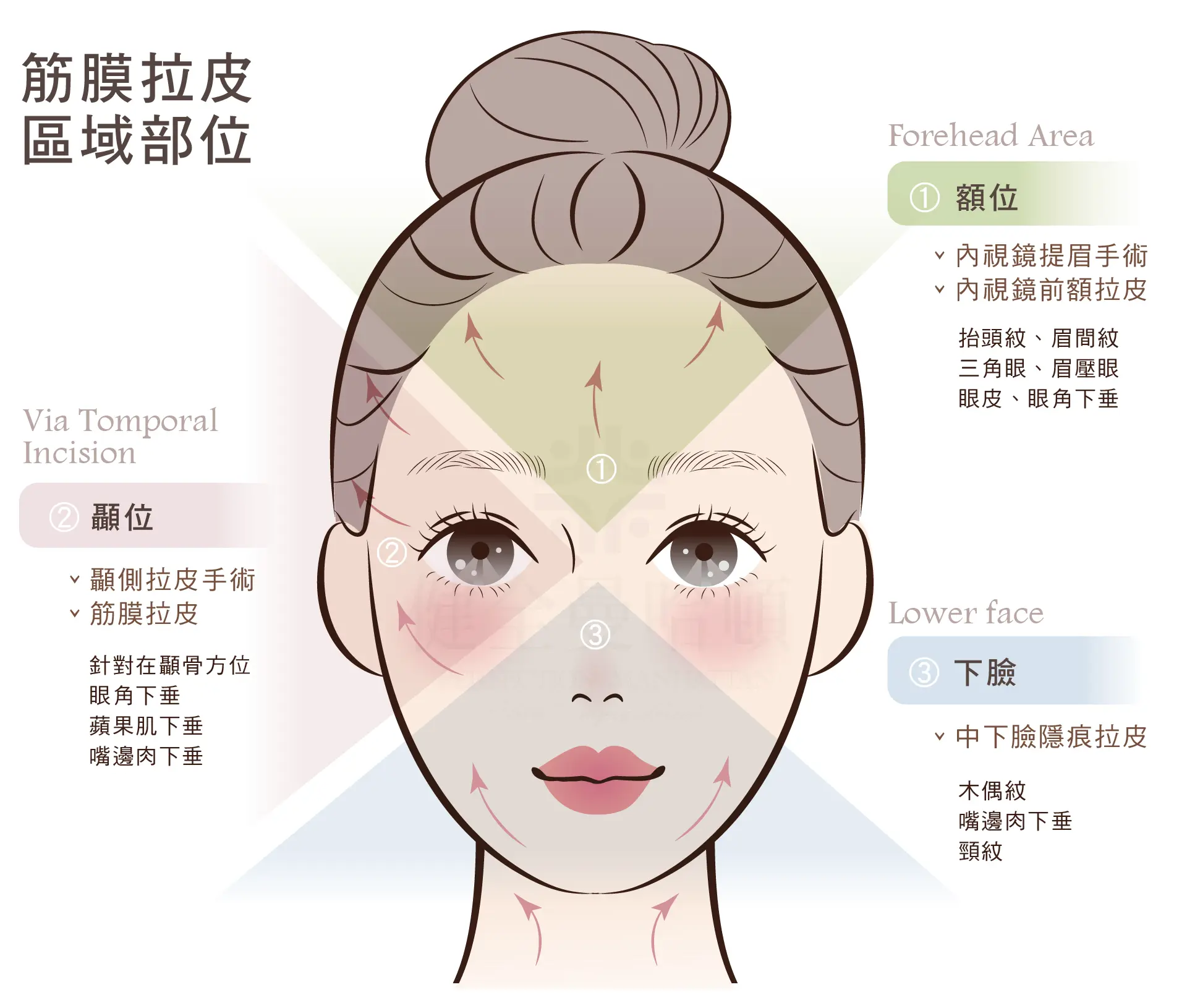 顳側拉皮 筋膜拉皮 2