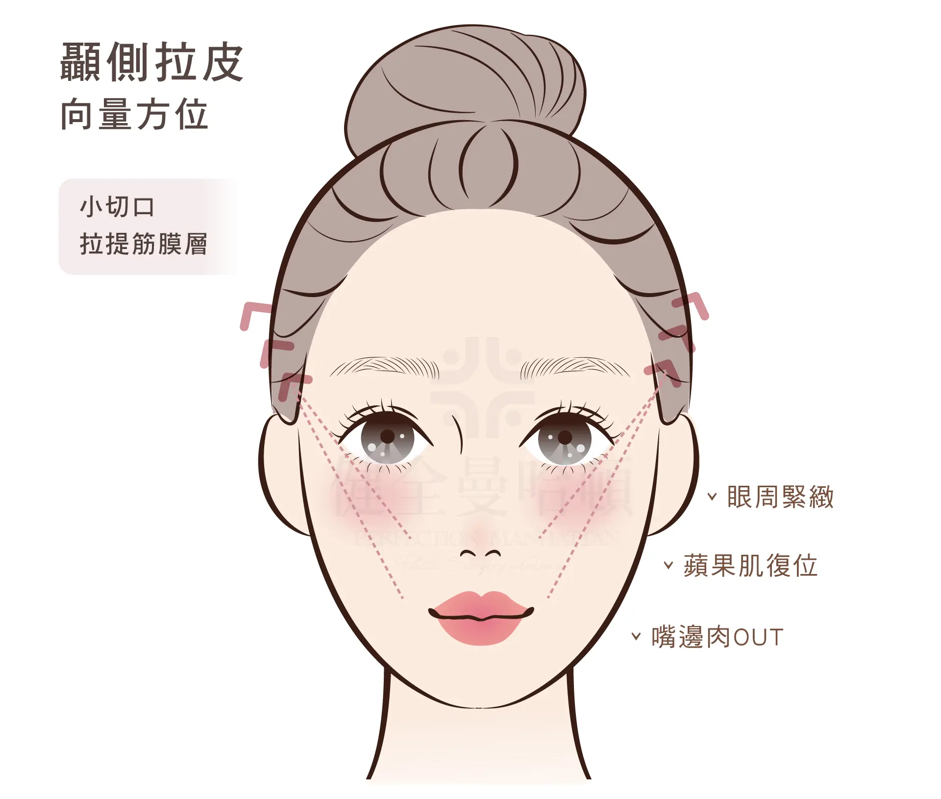 顳側拉皮 顳側拉皮 1