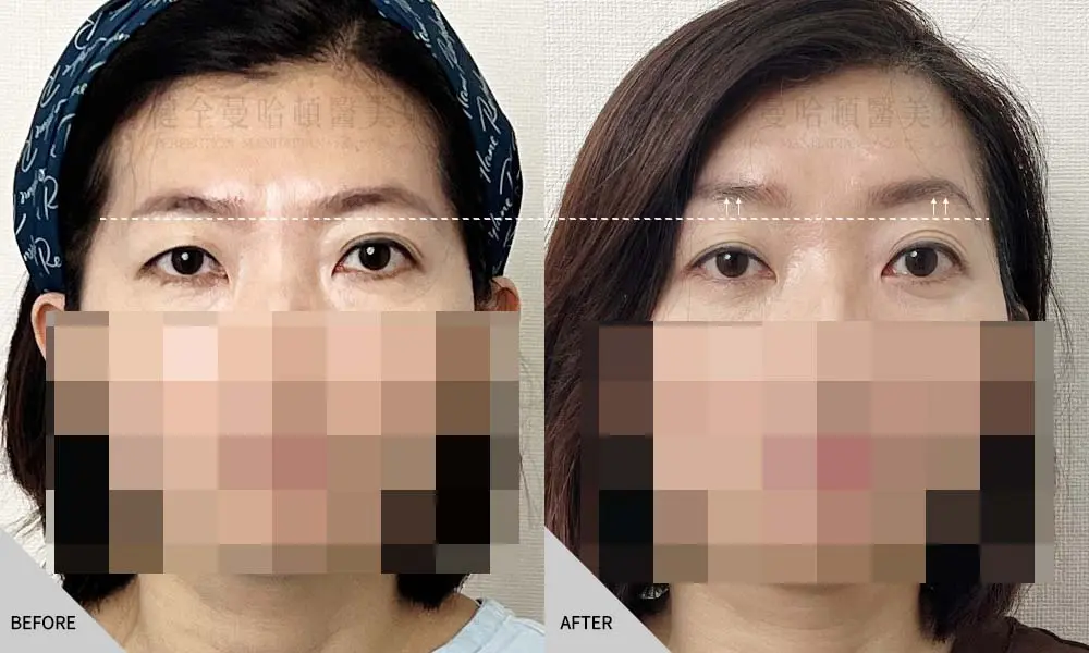 魏君霓 內視鏡提眉