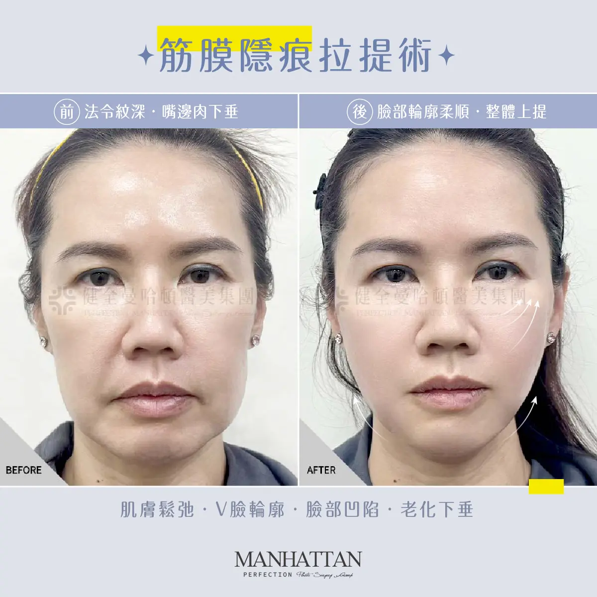 BA 陳嬿竹 筋膜拉提 1200x1200px 01
