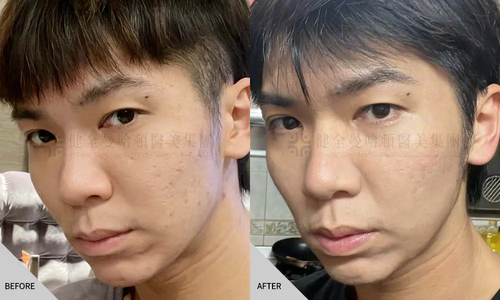 鄭中豪 光梭雷射 