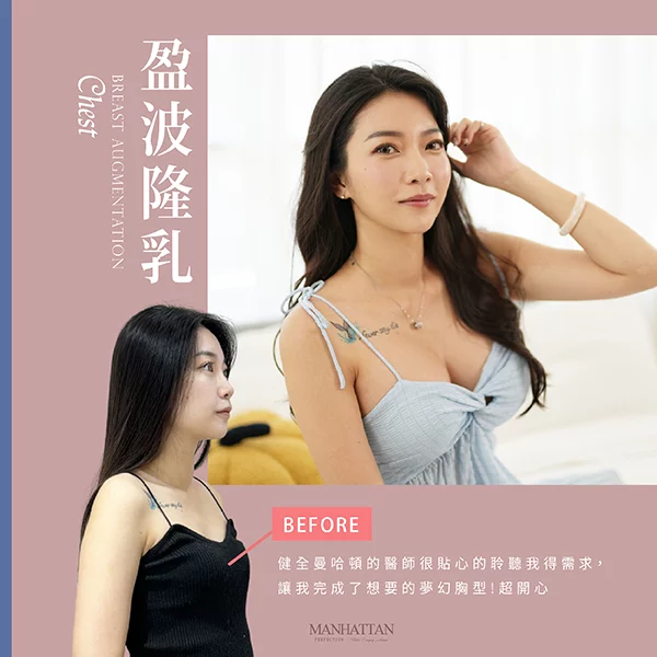 隆乳 簡怡萱 02