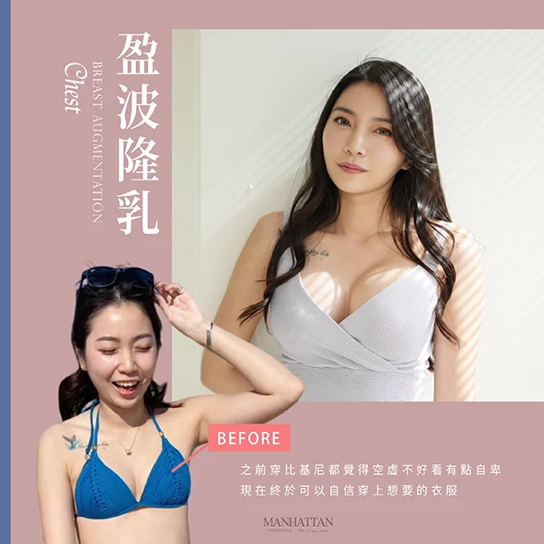 隆乳 簡怡萱 03
