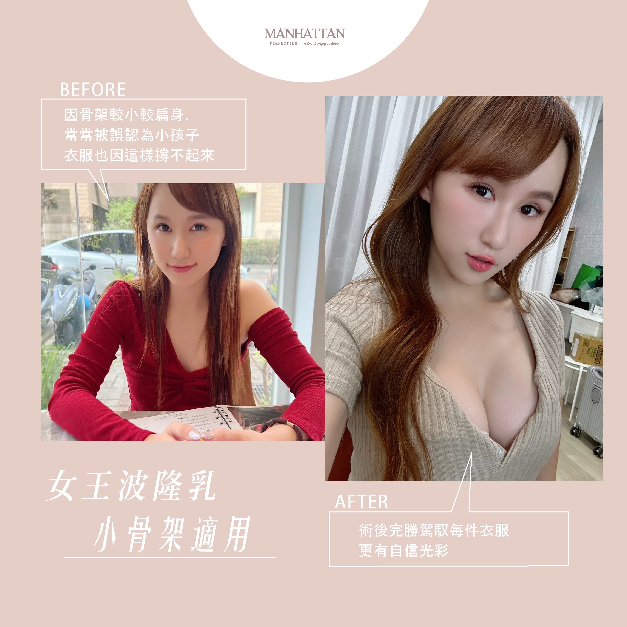 隆乳 郭惠瑜 02