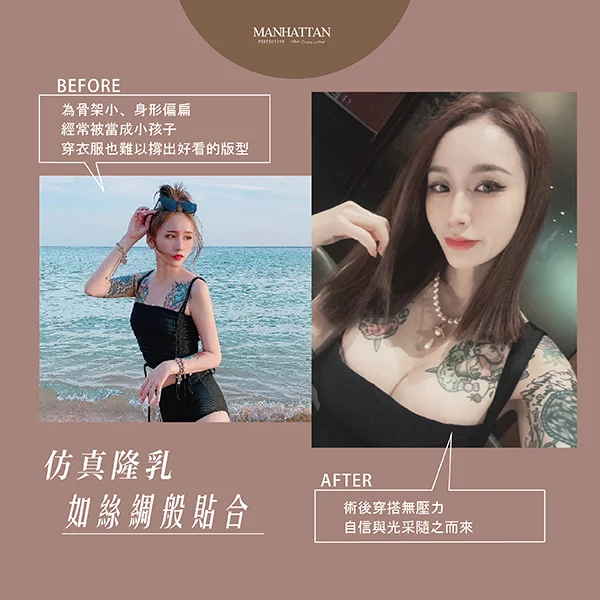 隆乳 黃昱綺 03