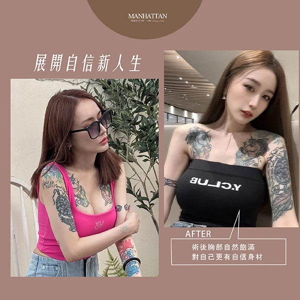 隆乳 黃昱綺 04