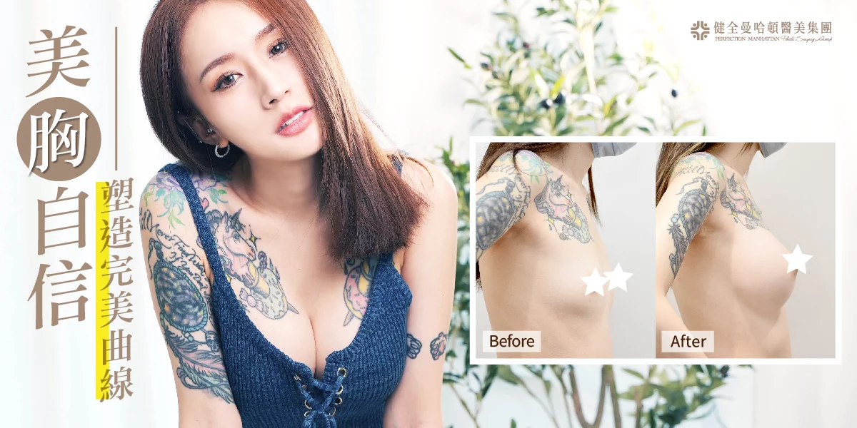 隆乳 黃昱綺 05