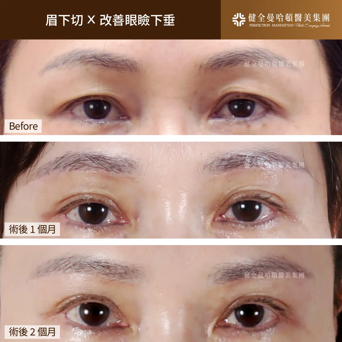 BA 劉恬良 眉下切X改善眼瞼下垂 1007 04