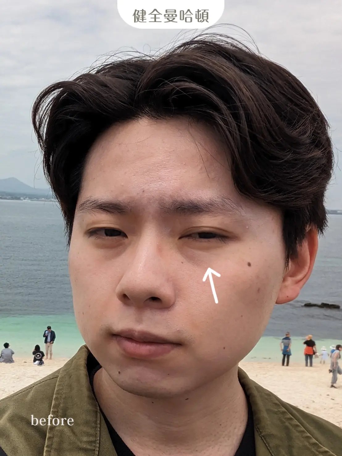 李沅勳 眼袋術前