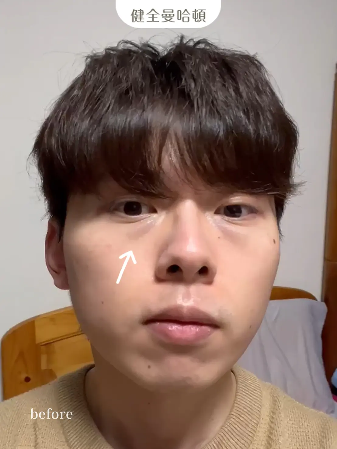 李沅勳 眼袋術前2