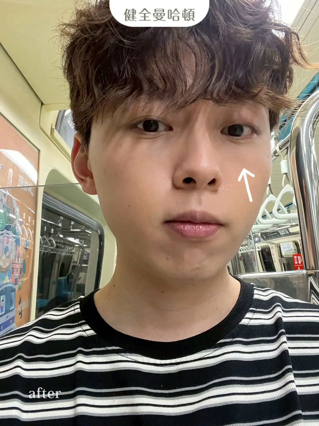 李沅勳 眼袋術後